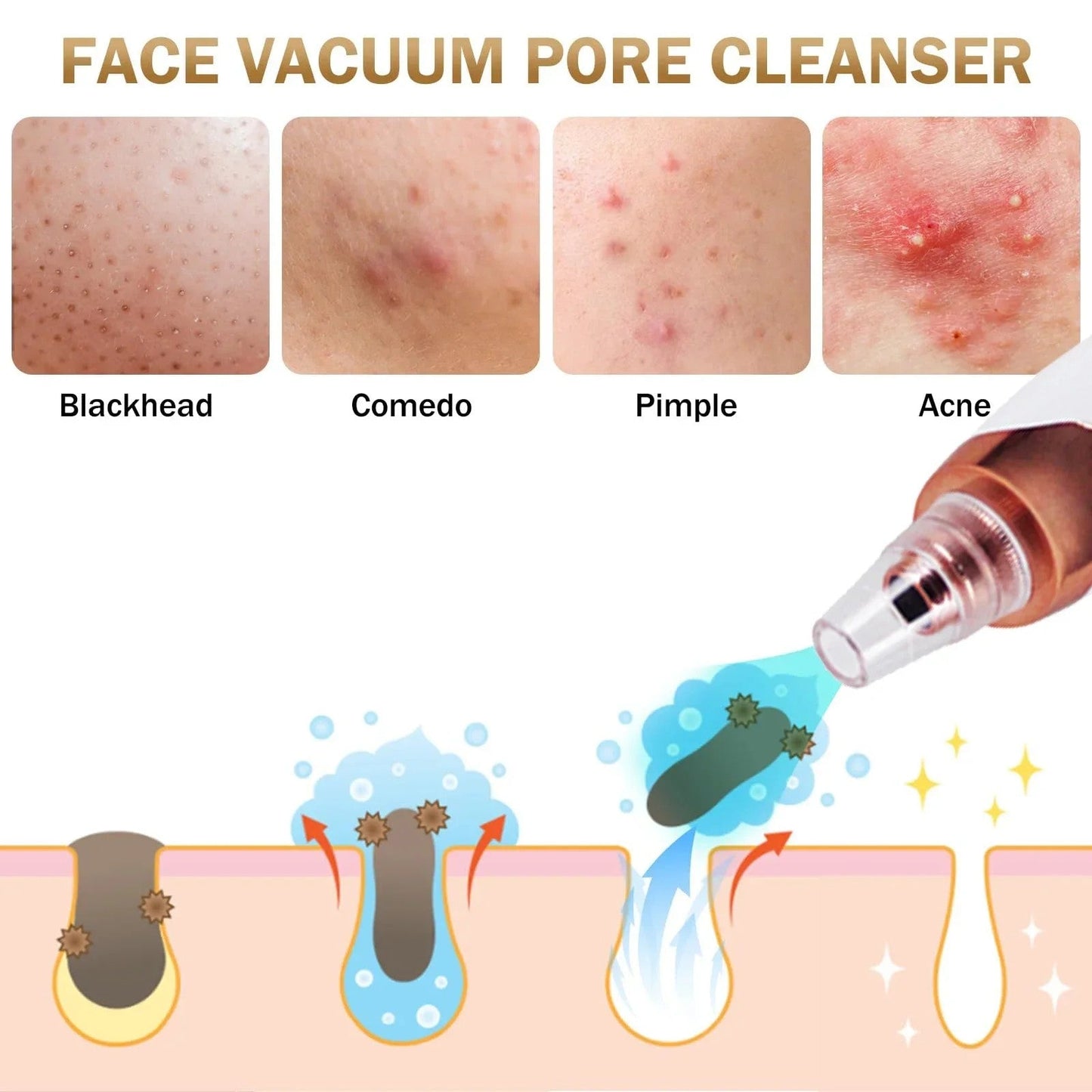 GCS Electric Blackhead Remover