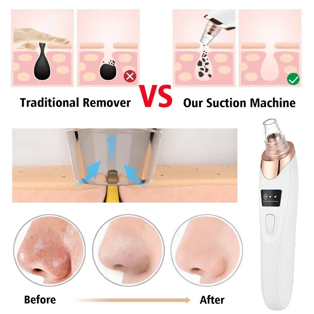 GCS Electric Blackhead Remover