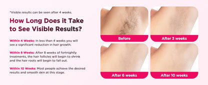 GCS Ice Cooling Laser Hair Removal