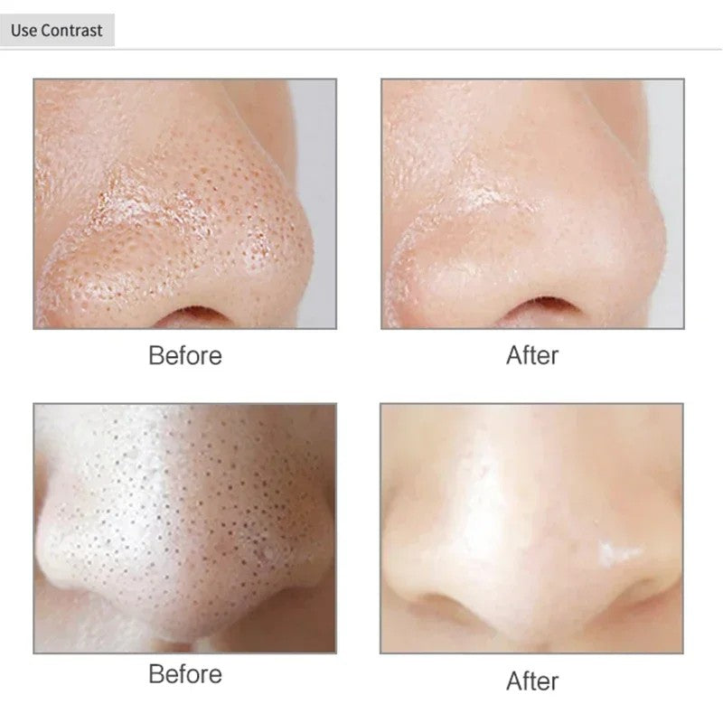 GCS Electric Blackhead Remover